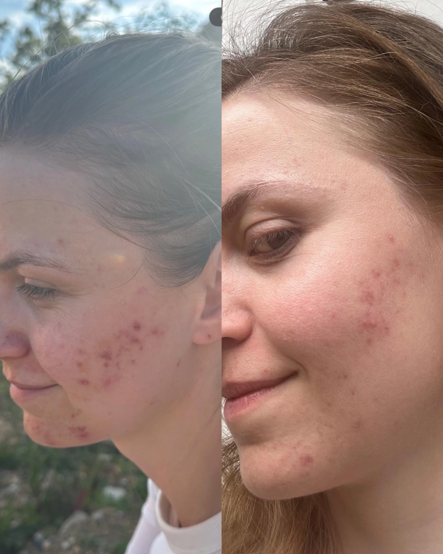 Průběh ošetření akné v salonu Beauty Beauty